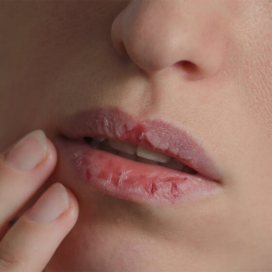 How to Stop Bleeding Lips | Causes and DIY methods