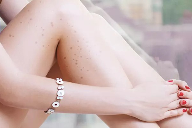 Dark spots on legs: causes, home remedies and treatment